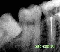Ретенция и дистопия Зуба Мудрости